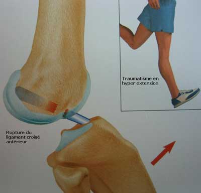 Les ligaments du genou: infos et conseils sur Les ligaments du genou
